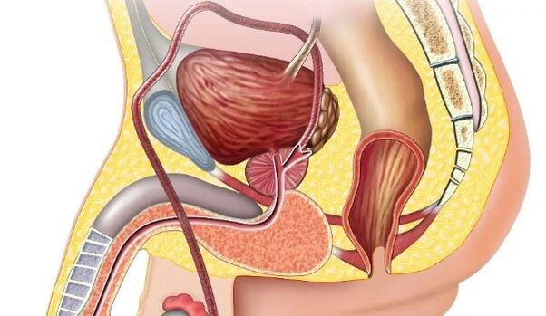 Chronic prostatitis