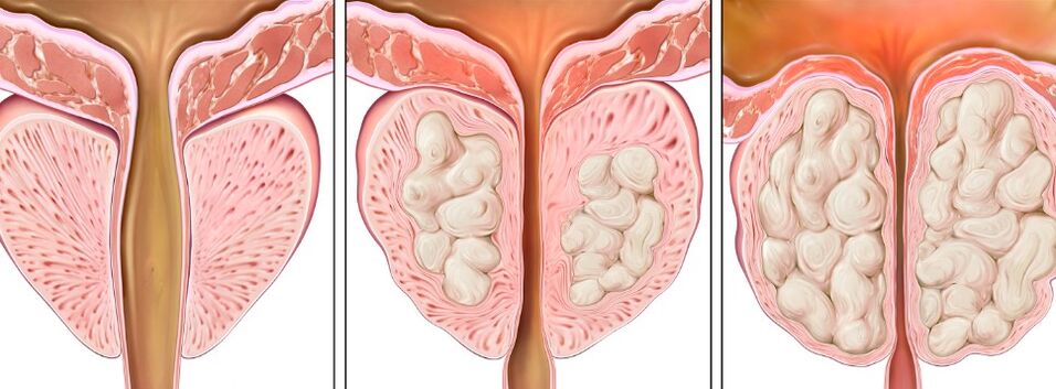The stage of prostatitis