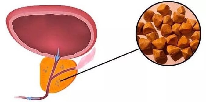 prostate