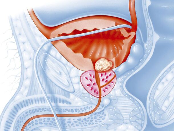 Bacterial forms of prostatitis